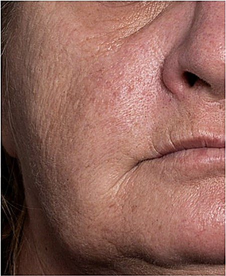 Customer skin after using Alkaglam