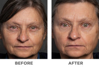before and after tight skin